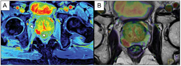ressonância magnética multiparamétrica