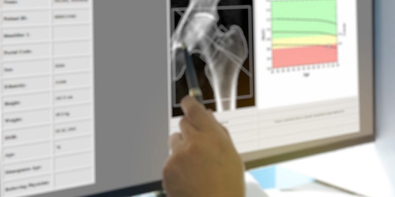 Densitometria Óssea